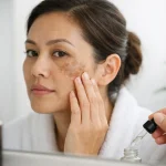 Cara Rawat Melasma Degil Dengan Selamat
