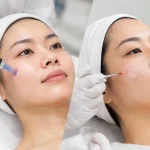 Dermapen vs TCA Cross: Mana Lebih Tepat?