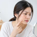 Mengapa Jerawat Muncul Selepas 30 Tahun?